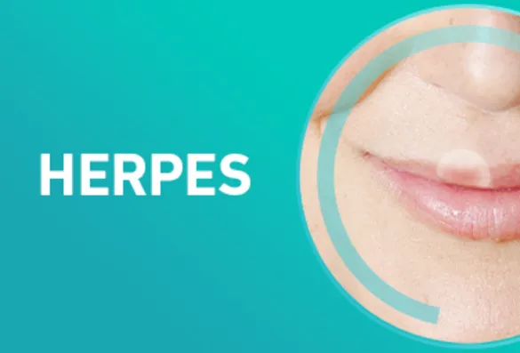 Compeed Herpes Pflaster